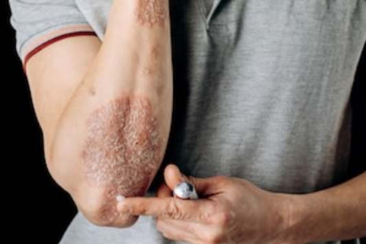 Natural Healing: Benefits of Organic Skincare Products for Psoriasis and Eczema